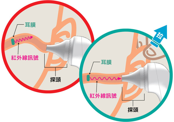 将耳道拉为较平直有助更准确量度耳膜温度。