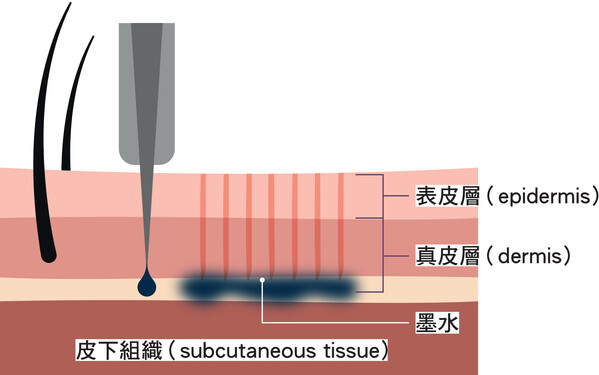 圖一：在紋身的過程，紋身針會重複刺穿皮膚的表皮層（epidermis），讓墨水穿過表皮進入真皮層（dermis）。